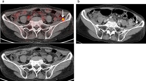 Muscle metastasis developed in a 73-year-old female following treatment for malignant pleural mesothelioma, including neoadjuvant chemotherapy, pleurectomy and decortication procedures, and chemotherapy.