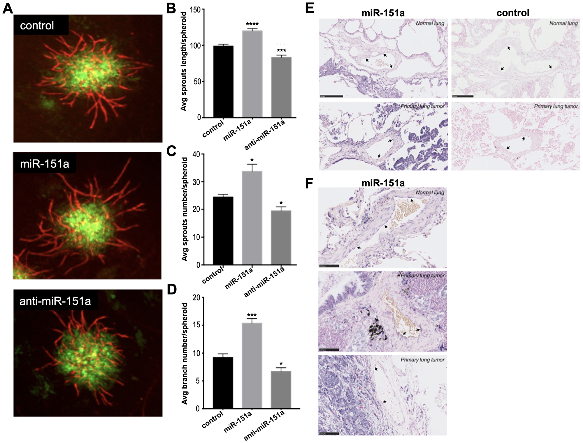 miR-151a enhances angiogenesis in 3D vascularized lung tumor spheroids and is expressed in vasculature of NSCLC patient specimens.