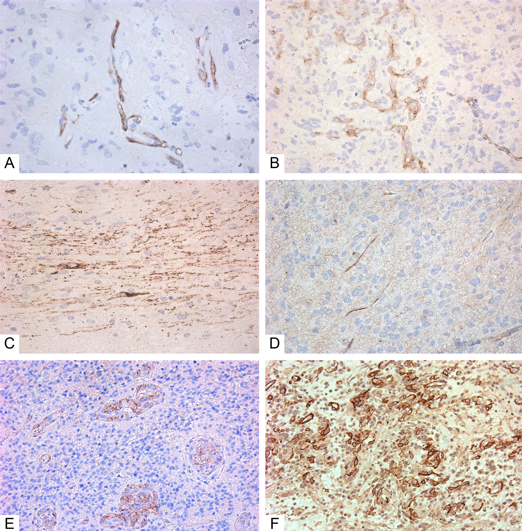 Immunohistochemistry of glioblastoma.