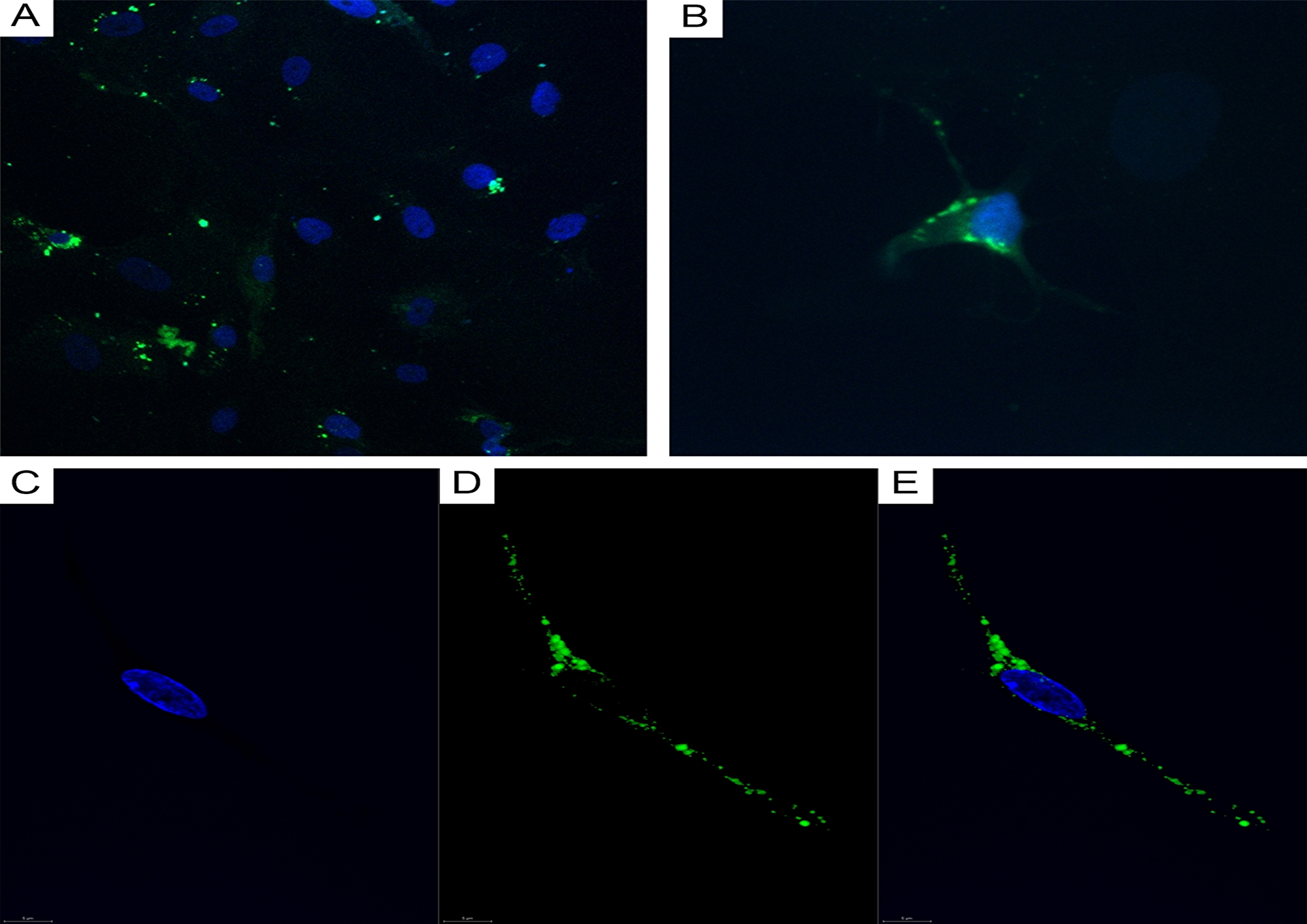 CLSM of glioblastoma and astrocytoma primary cultures.