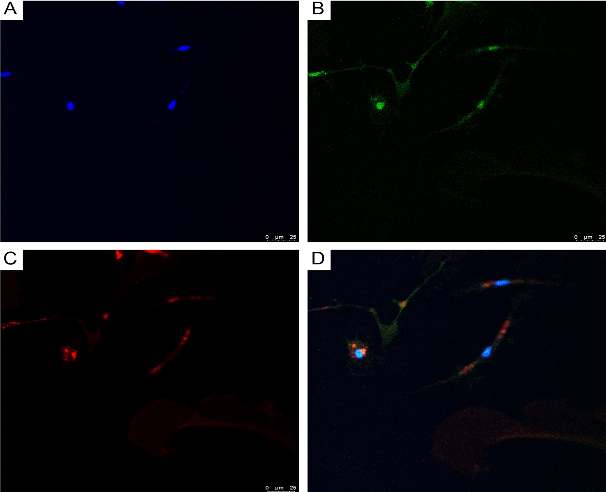 CLSM of glioblastoma primary culture.