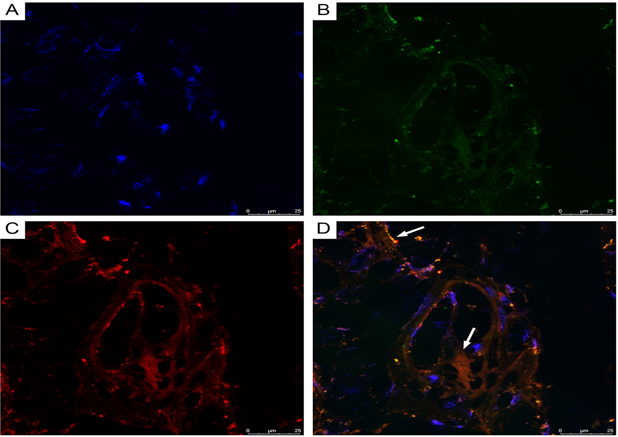 CLSM of glioblastoma.