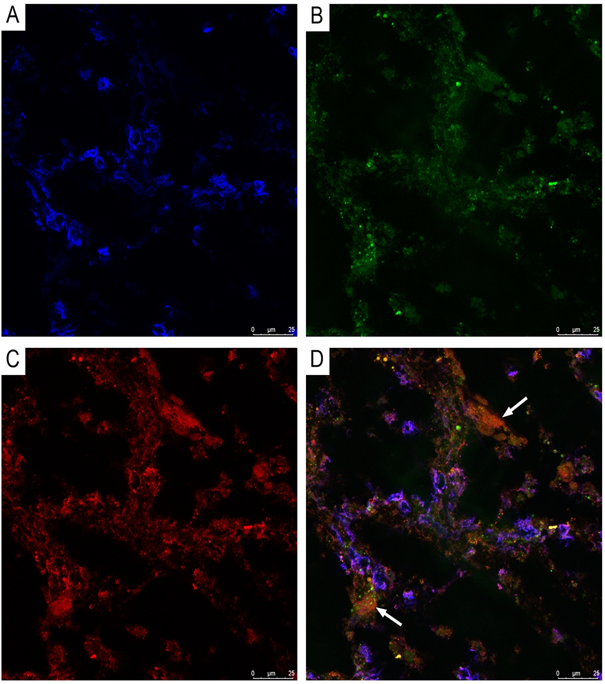 CLSM of glioblastoma.