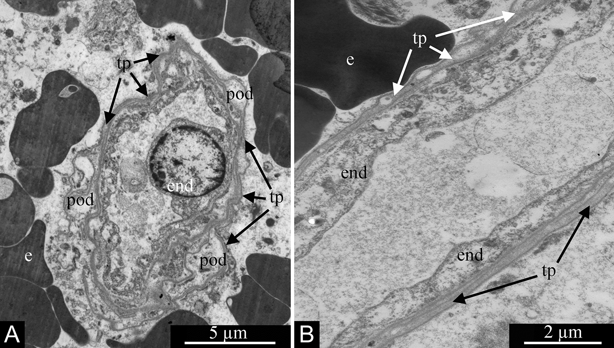 Processes of telocytes (telopodes) in glioblastoma &rsquo;s blood capillaries.