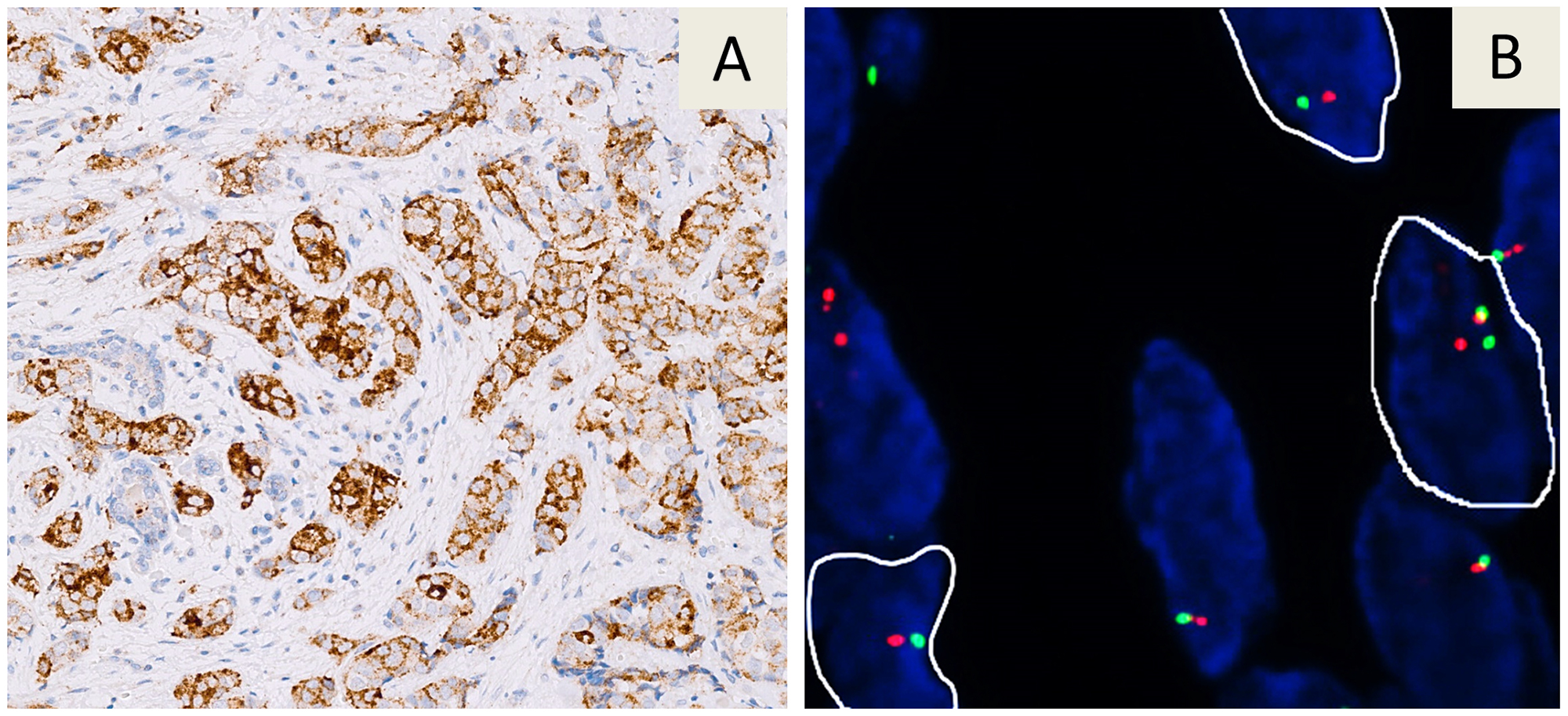 Immunohistochemical staining with the VENTANA pan-TRK (EPR17341) assay in a breast carcinoma.