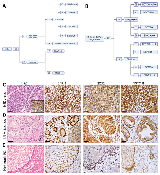 Immunohistochemical features of low- and high-grade foci in the primary PCa.