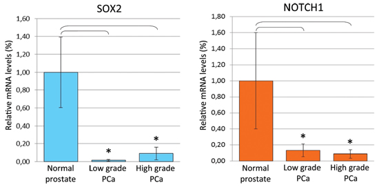 SOX2 and NOTCH1 mRNA expression in normal and cancerous prostate epithelium from PCa patients.