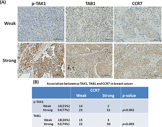 Association between p-TAK1, TAB1 and CCR7 in breast tumors.