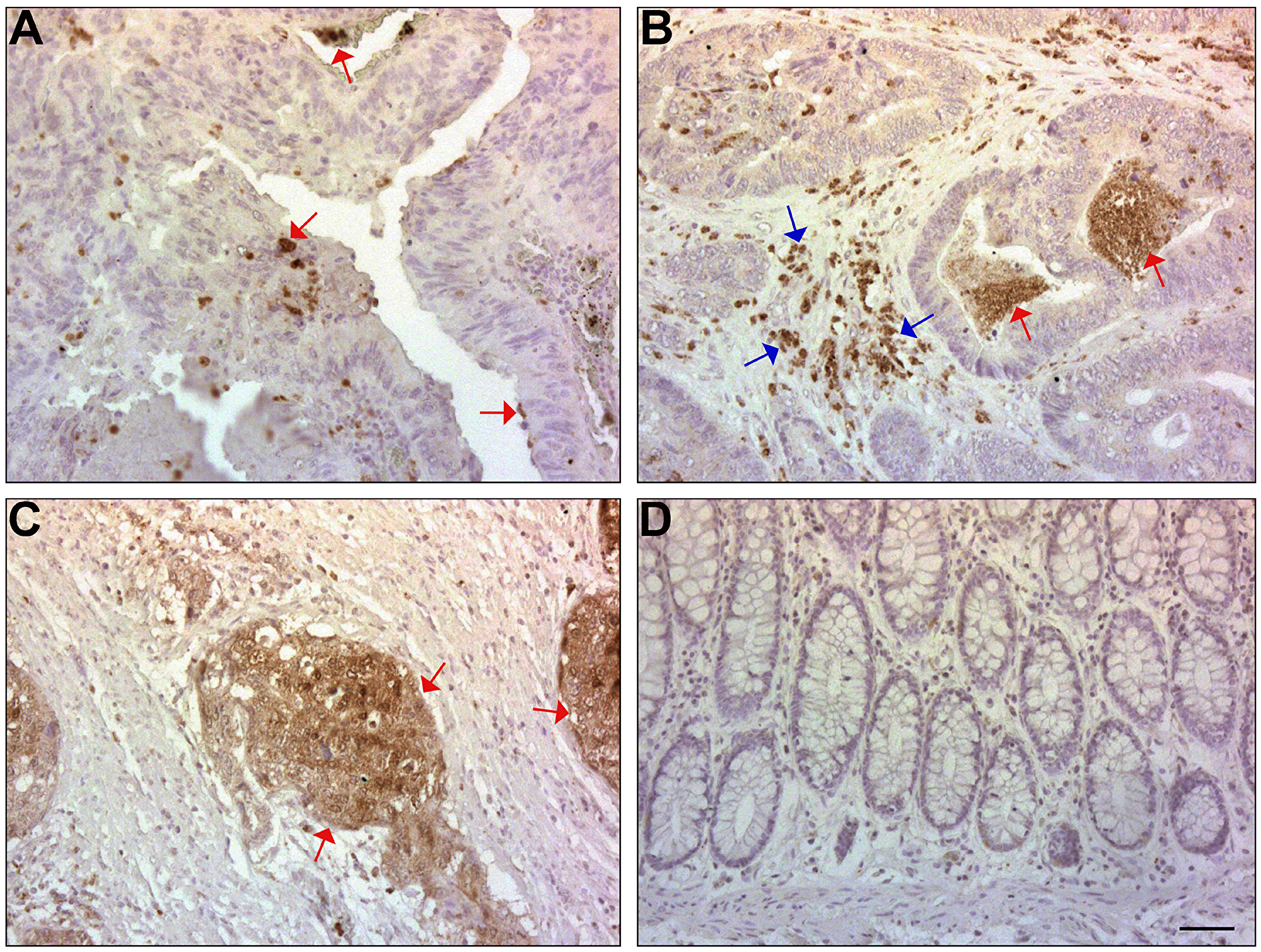 ISG15 expression is induced in CRC tissue and in the adjacent stroma, but not in normal mucosa of the colon.