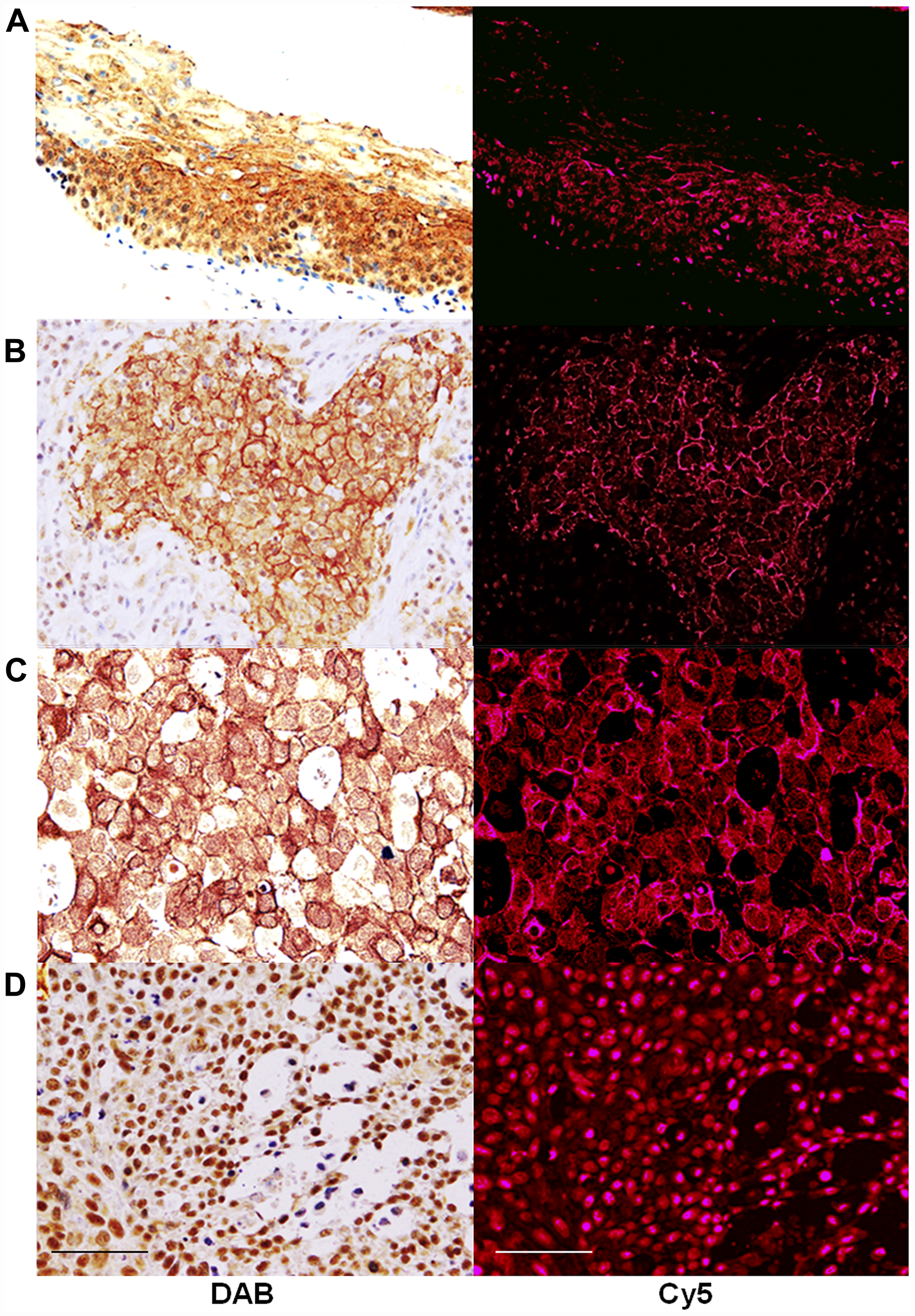 Expression of CLDN4 in oral squamous cell carcinomas.