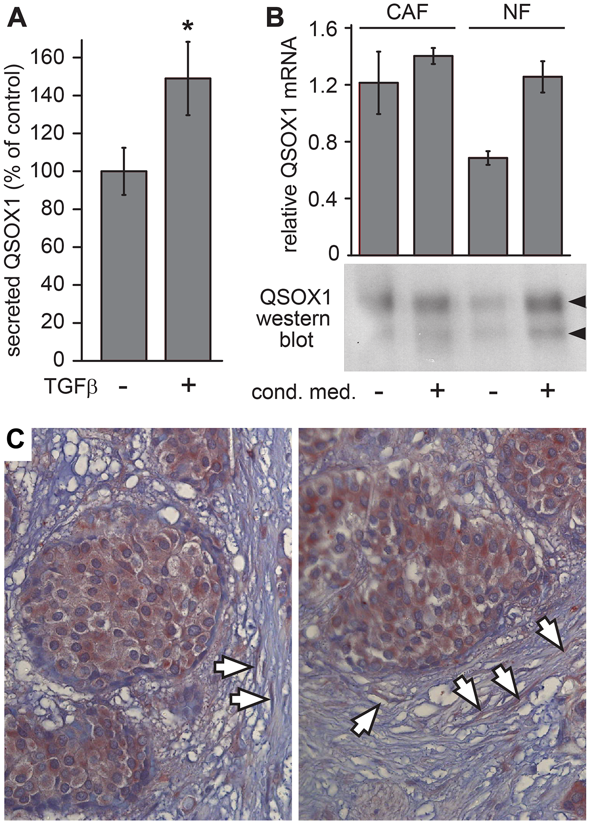 QSOX1 production by tumor-associated fibroblasts.