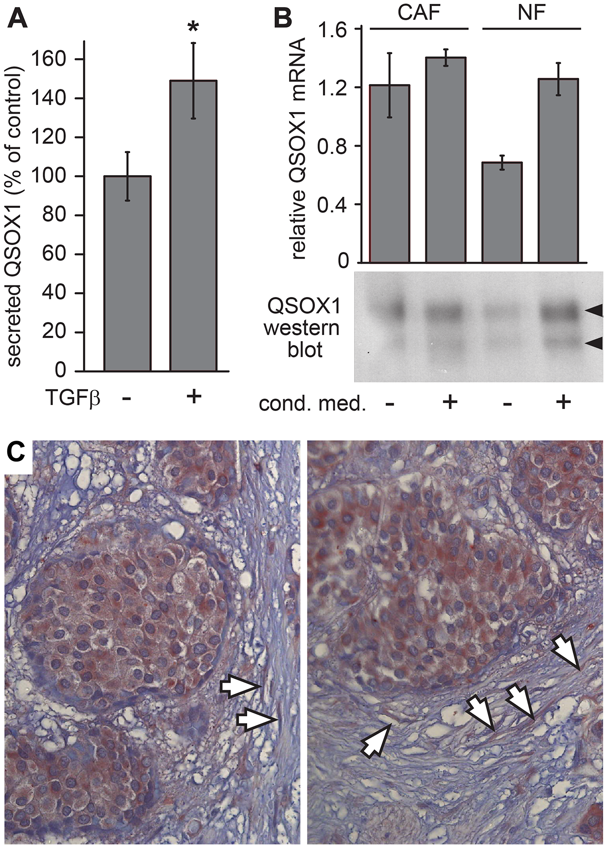 Figure 1: QSOX1 production by tumor-associated fibroblasts.