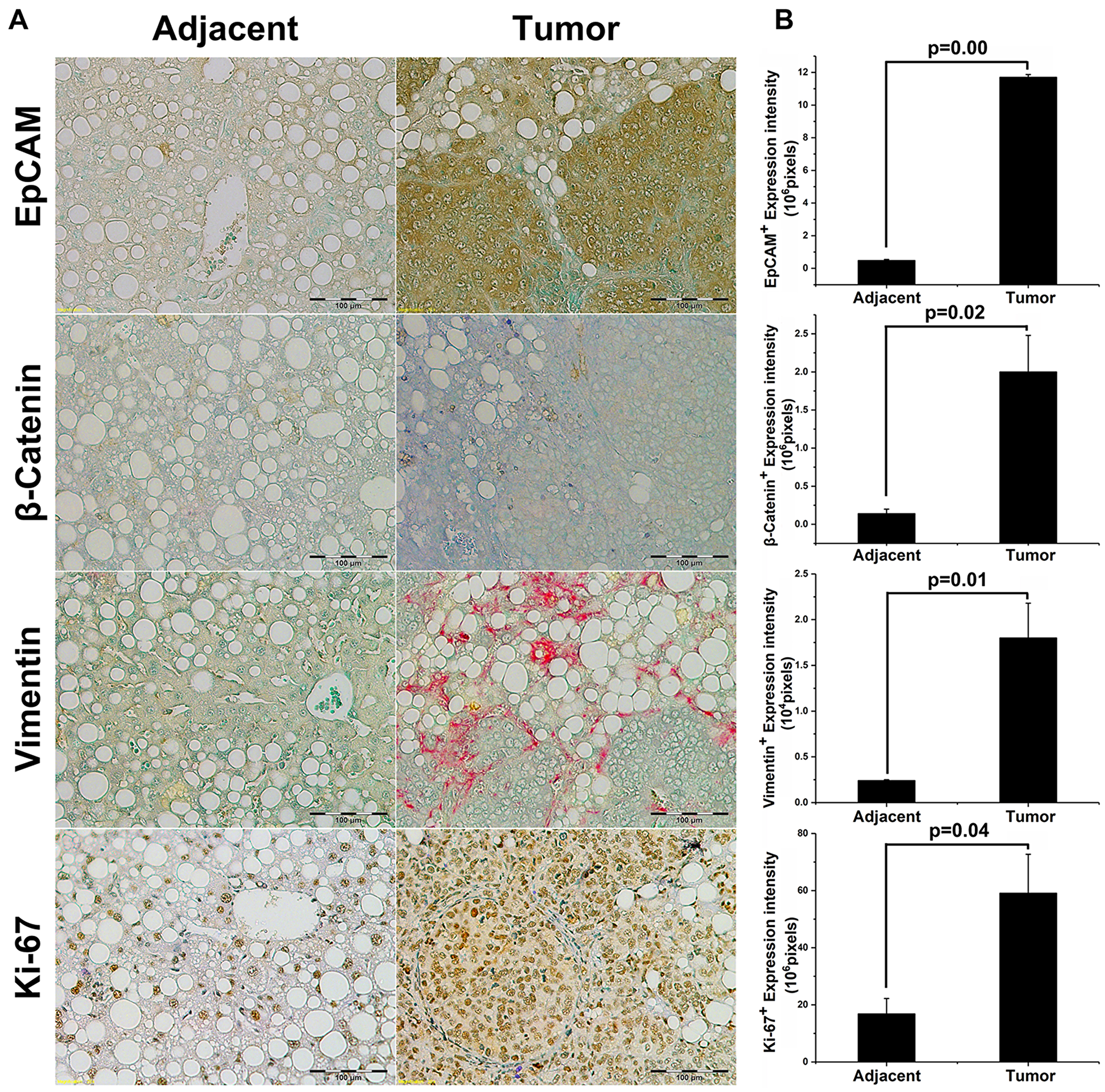 Tumor initiation in EpCAM+ NASH animals exhibits aggressive HCC tumorigenesis.