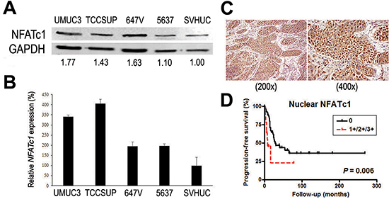 Expression of NFATc1 in bladder cancer.