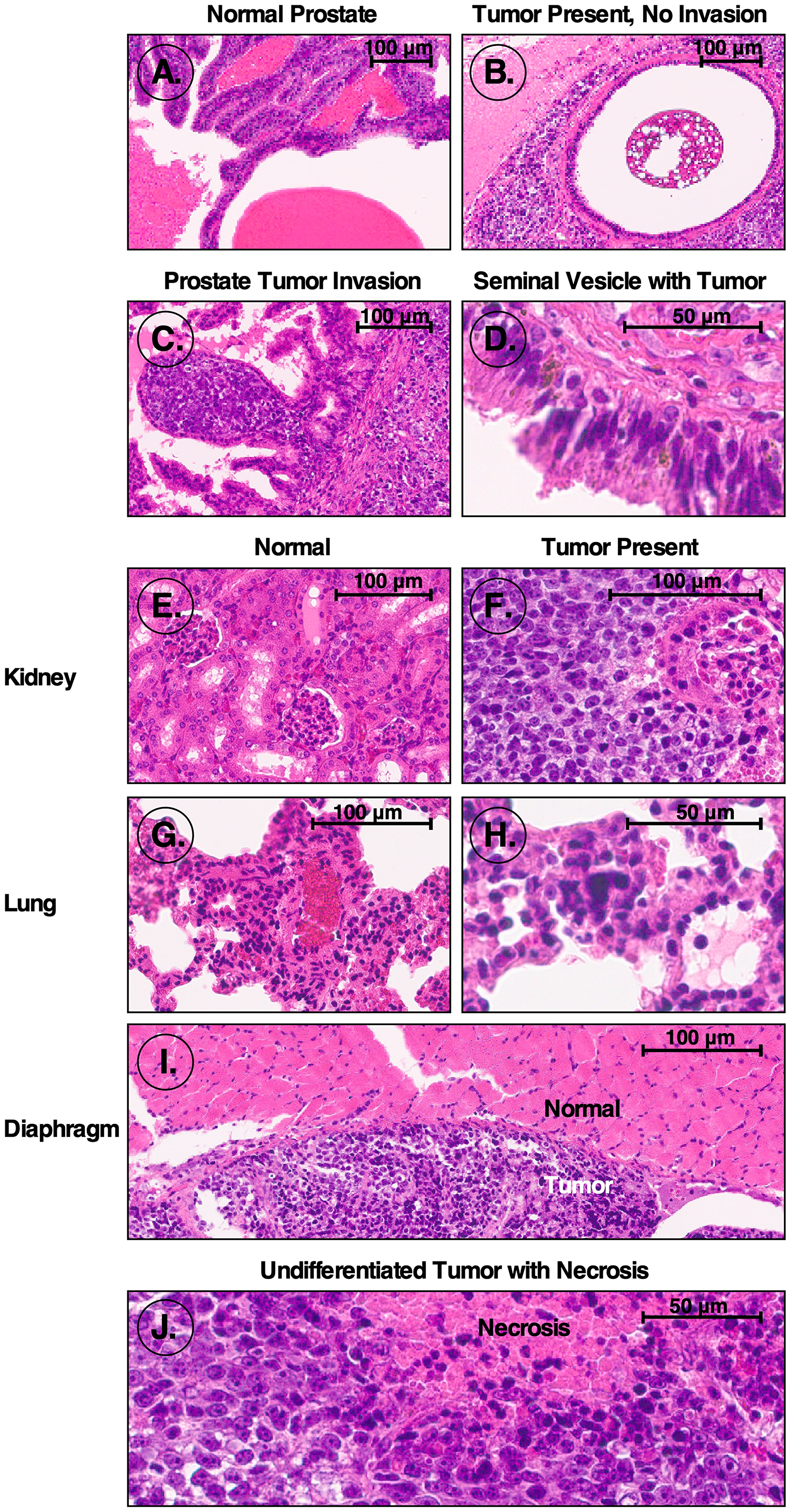 Figure 1: H&E stained sections from mice orthotopically injected with iPS87 cells.