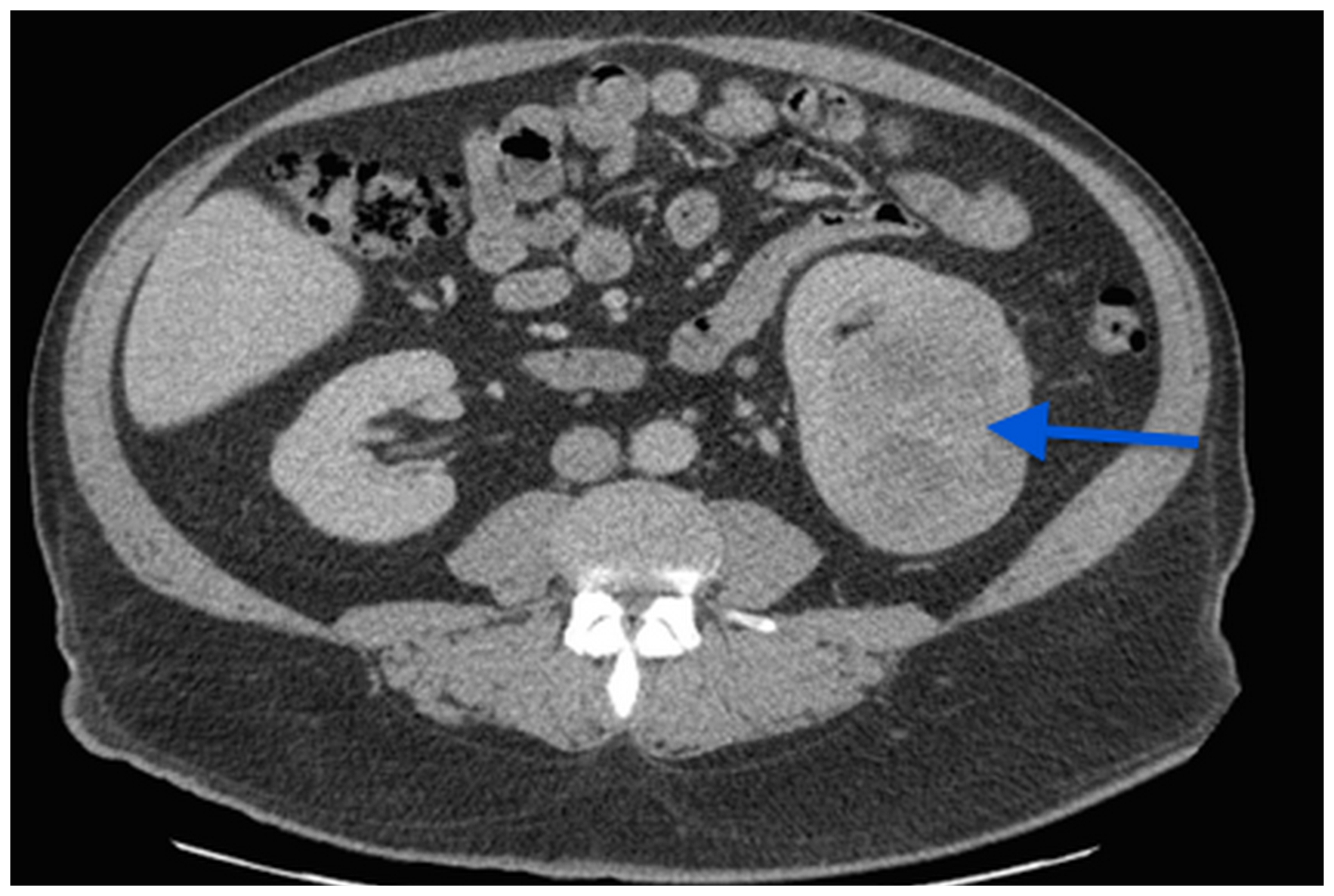 A CT scan image showing a 7 cm left kidney mass.