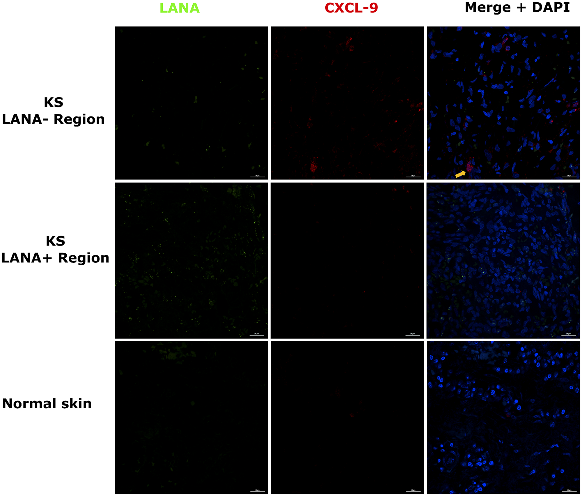 Dual-immunofluorescence staining of Kaposi’s sarcoma-associated Herpesvirus (KSHV) Latency Associated Nuclear Antigen (LANA) protein and C-X-C Motif Chemokine Ligand 9 (CxCL-9) on Kaposi’s Sarcoma (KS) tissues ID-C3057 (LANA+ and LANA- regions) and normal skin ID-21650.
