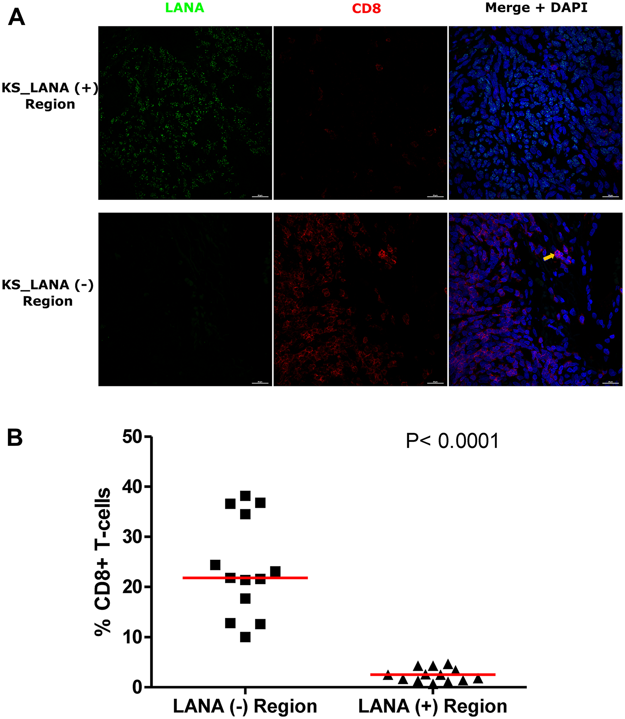 Dual-immunofluorescence staining of Kaposi’s Sarcoma-associated Herpesvirus (KSHV) Latency Associated Nuclear Antigen (LANA) protein and CD8+ T-cells on Kaposi’s Sarcoma (KS) tissues.
