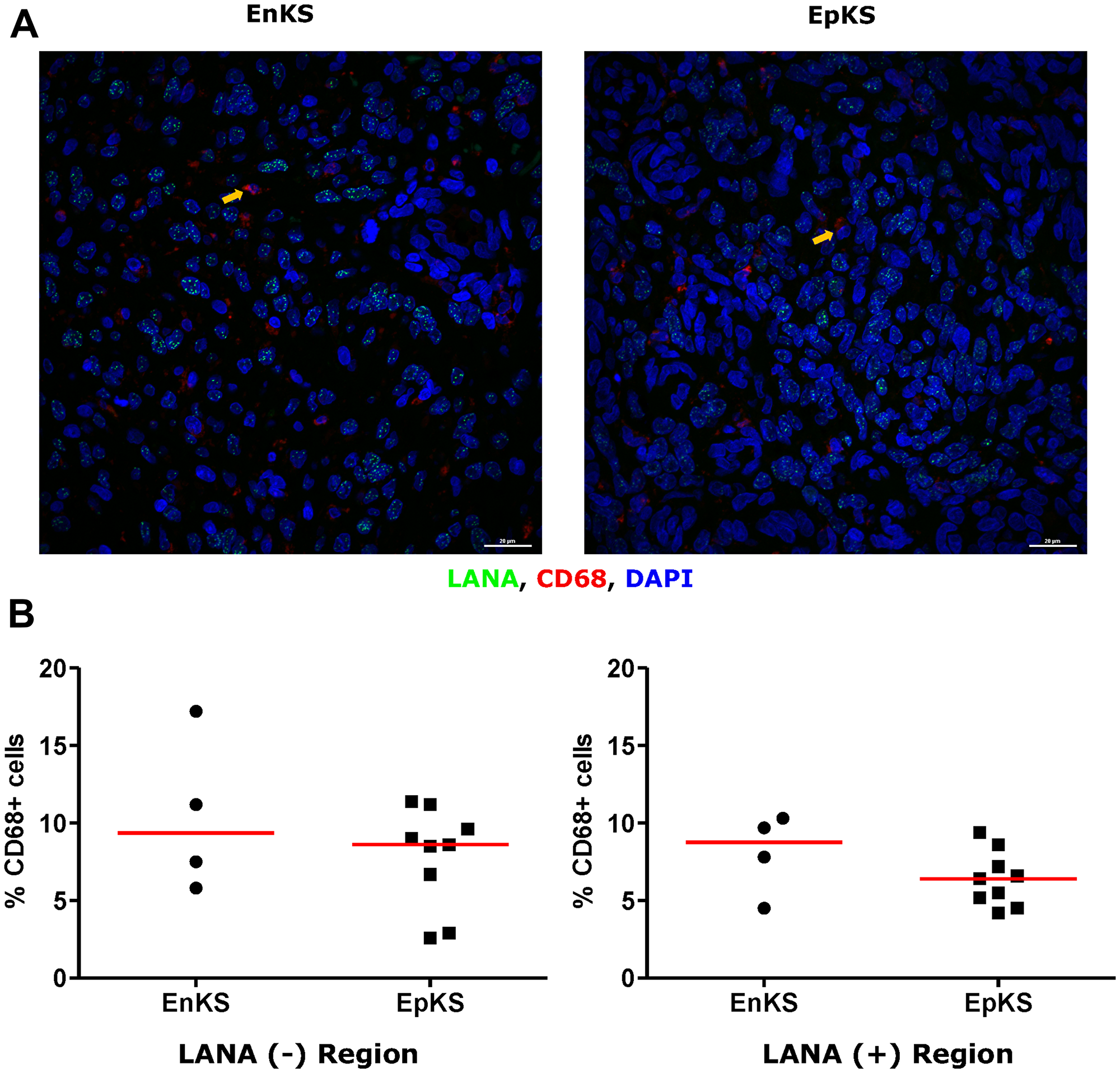 Dual-immunofluorescence staining of Kaposi’s Sarcoma-associated Herpesvirus (KSHV) Latency Associated Nuclear Antigen (LANA) protein and CD68 on Kaposi’s Sarcoma (KS) tissues.