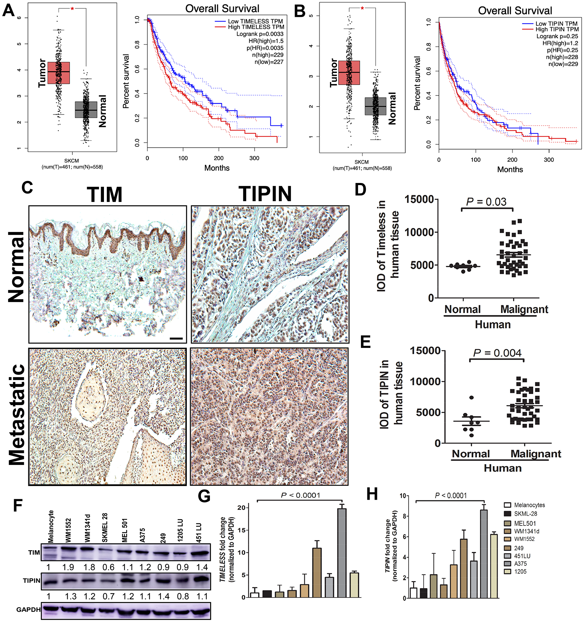 Figure 1: TIM and TIPIN are overexpressed in melanoma.