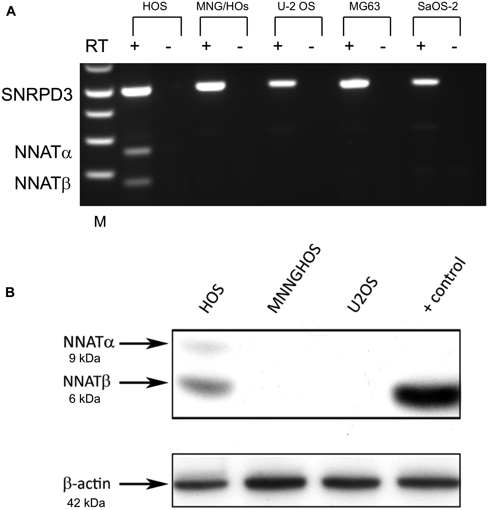 NNAT expression is detected in an osteosarcoma cell line exhibiting the normal imprinted hemimethylation pattern but not in cell lines exhibiting NNAT hypermethylation.