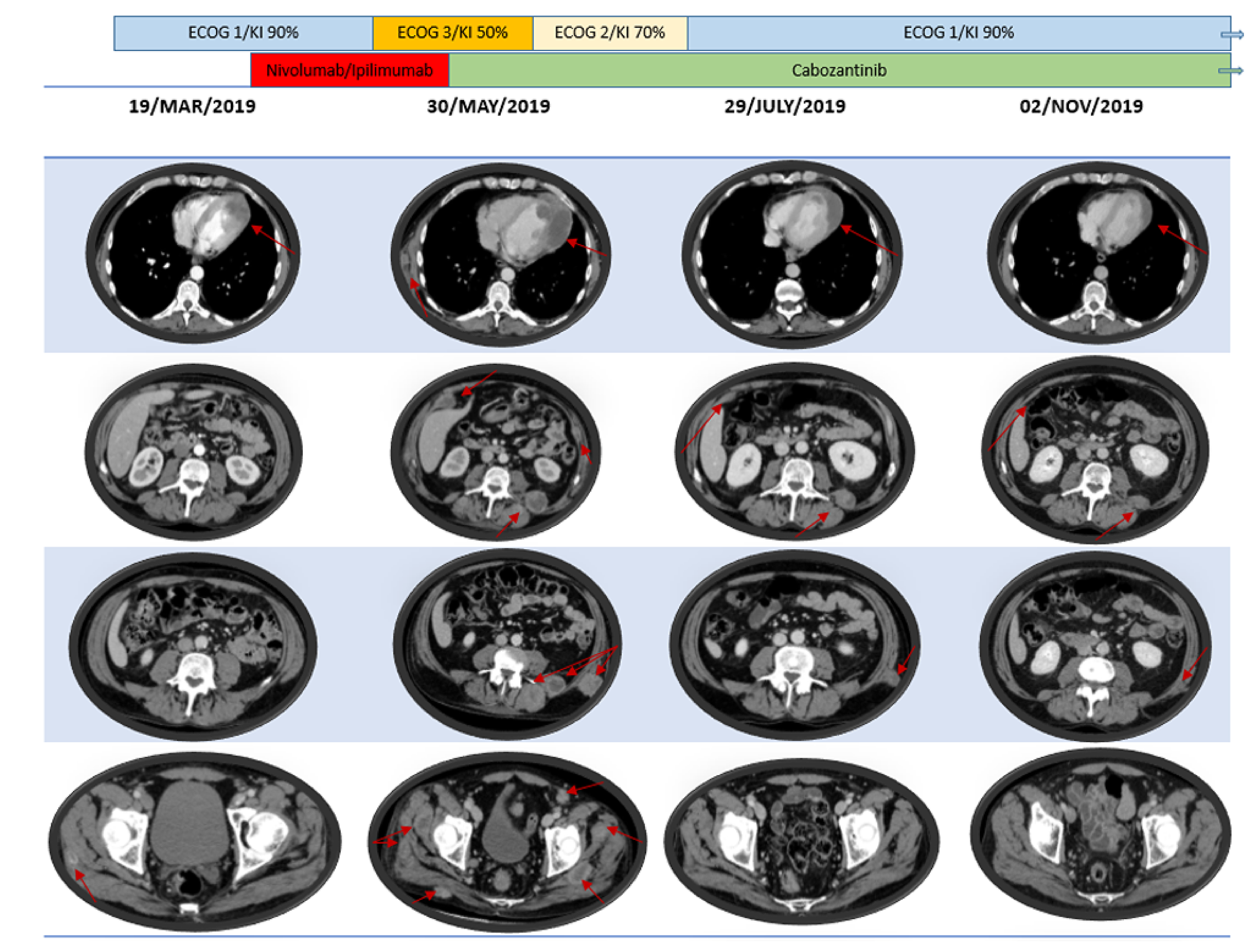 Patient’s radiology and clinical outcome according to systemic treatments.