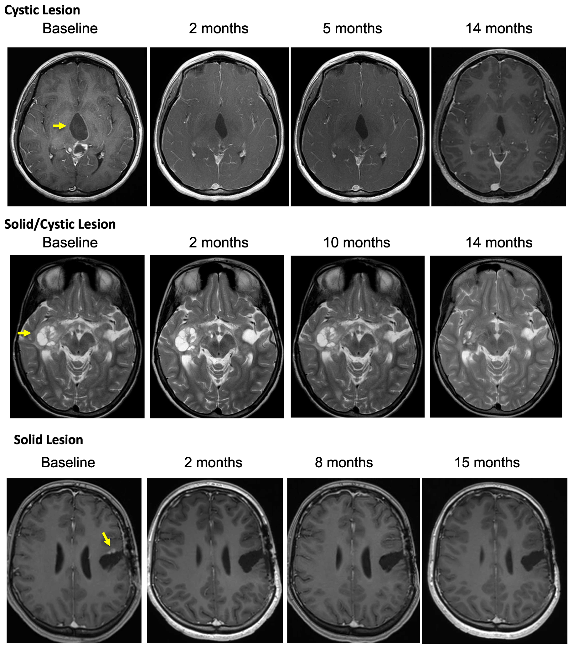 Depicted are representative images of subjects treated on PNOC-002 demonstrating.