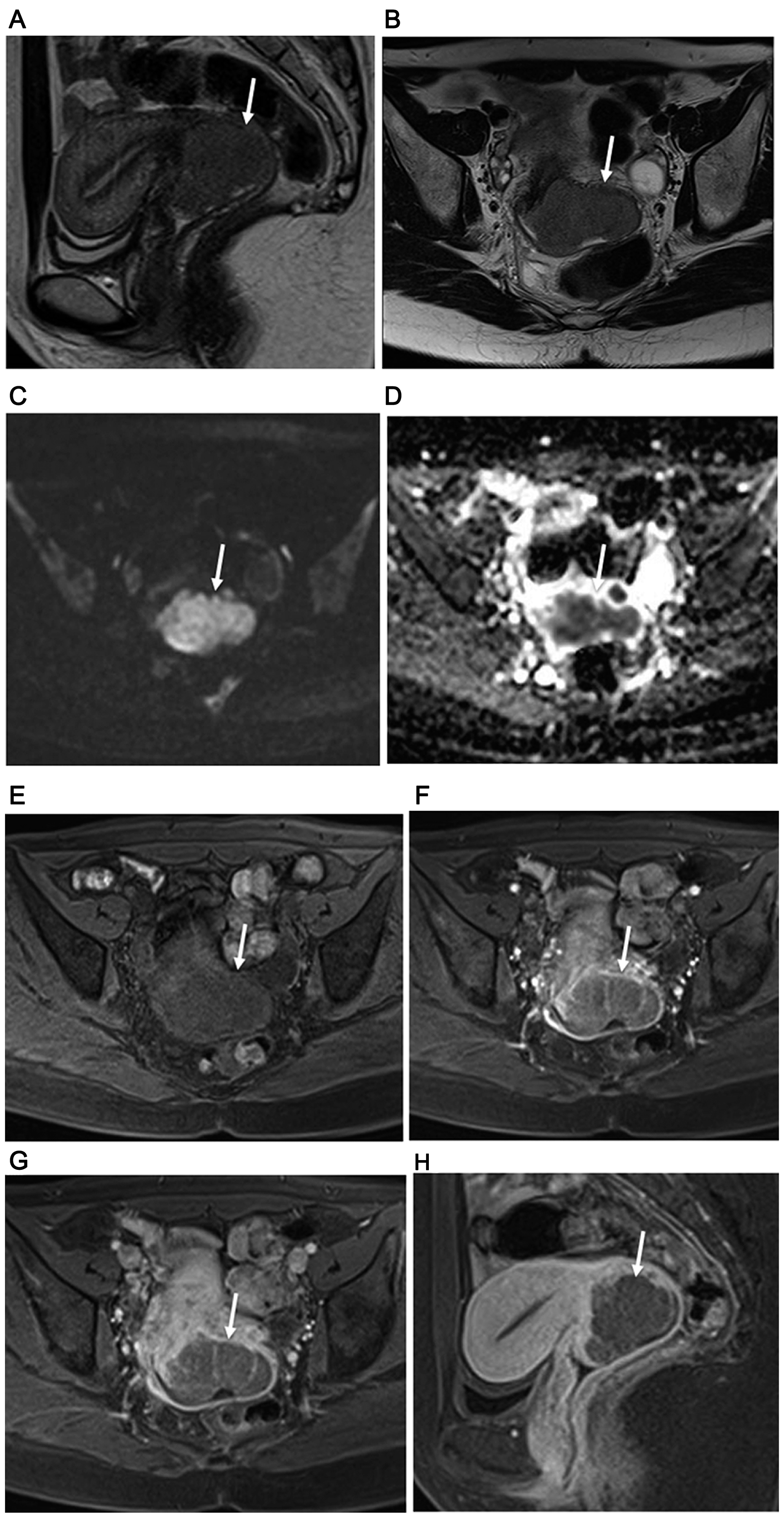 34-year-old woman with FIGO stage IB2 uterine cervical large cell neuroendocrine carcinoma.