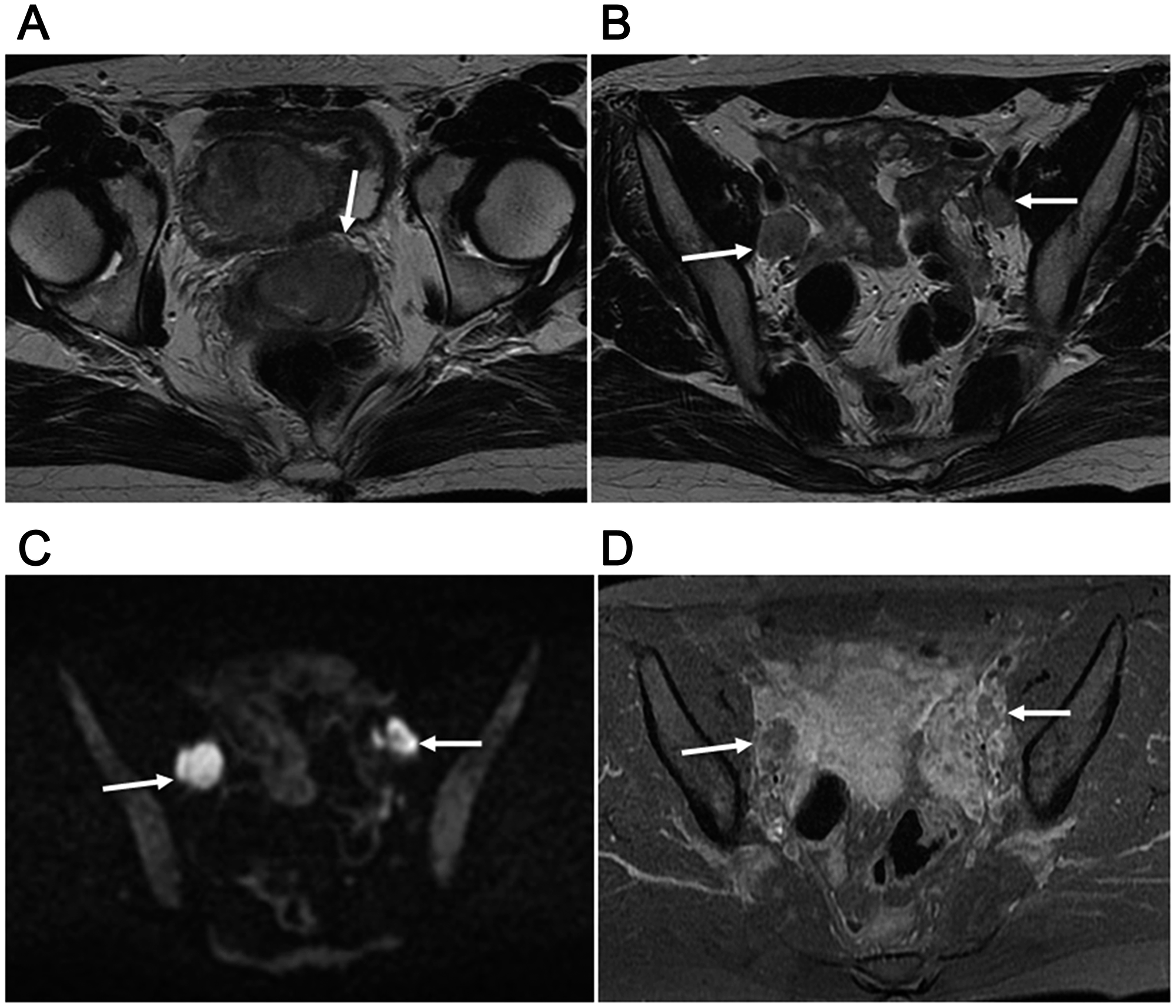 30-year-old woman with T2bN1M0 (stage IIIB) and FIGO stage IIB2 uterine cervical small cell carcinoma mixed with squamous cell carcinoma.