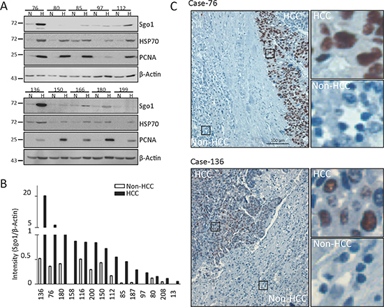 Sgo1 protein expression in HCC and adjacent non-HCC tissues.