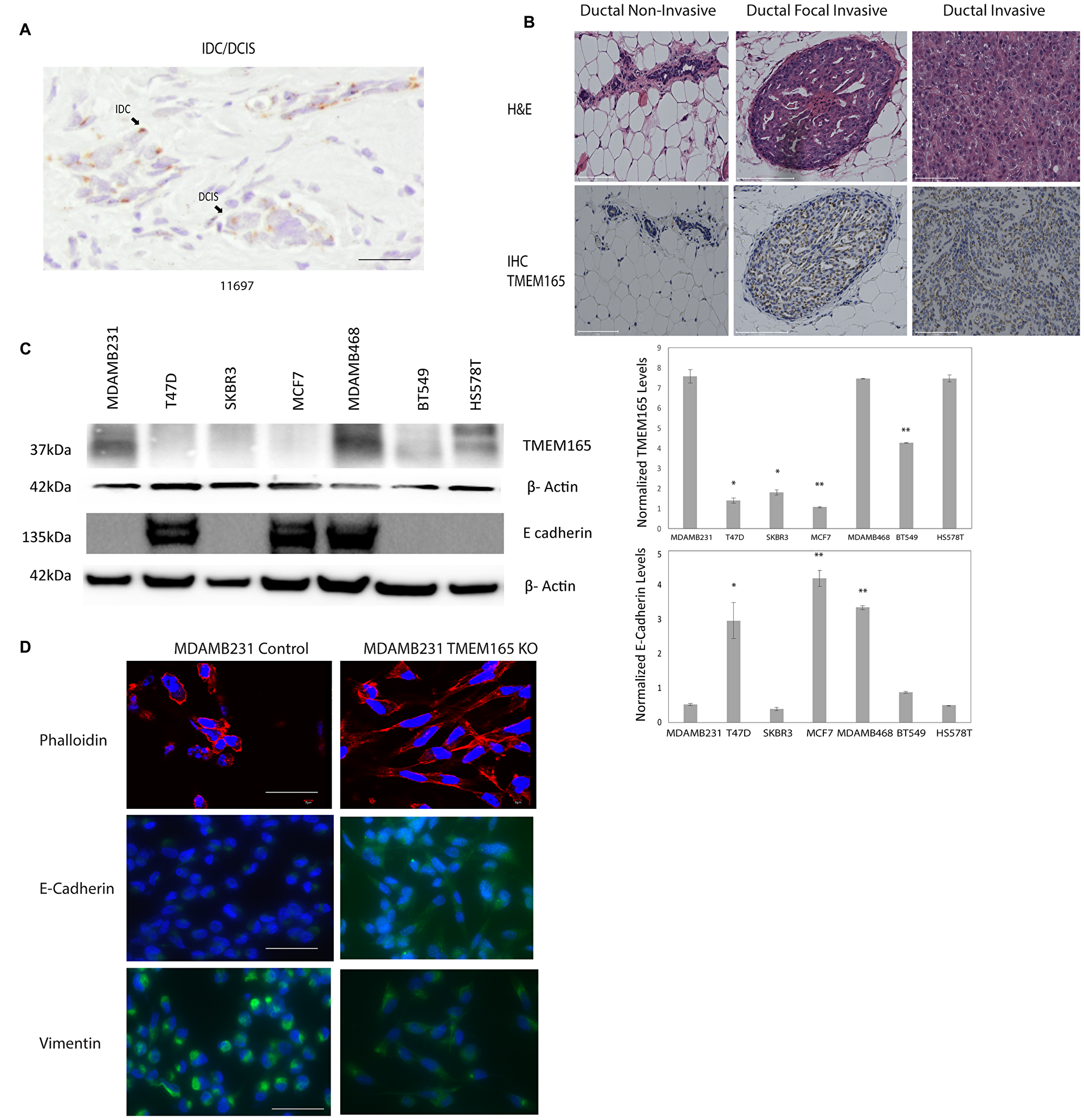 TMEM165 is increased in human breast cancer tissues and cell lines.