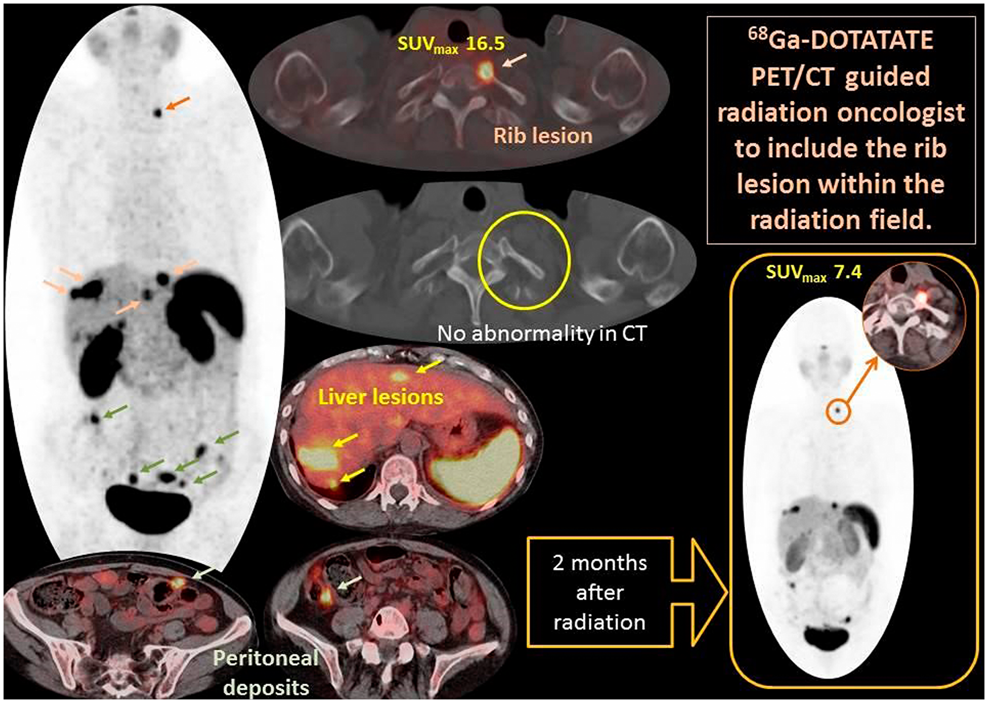 Demonstrates PET MIP image (Central) and fused PET/CT axial images of a case example of gallium- 68 DOTATATE that influenced and guided management.