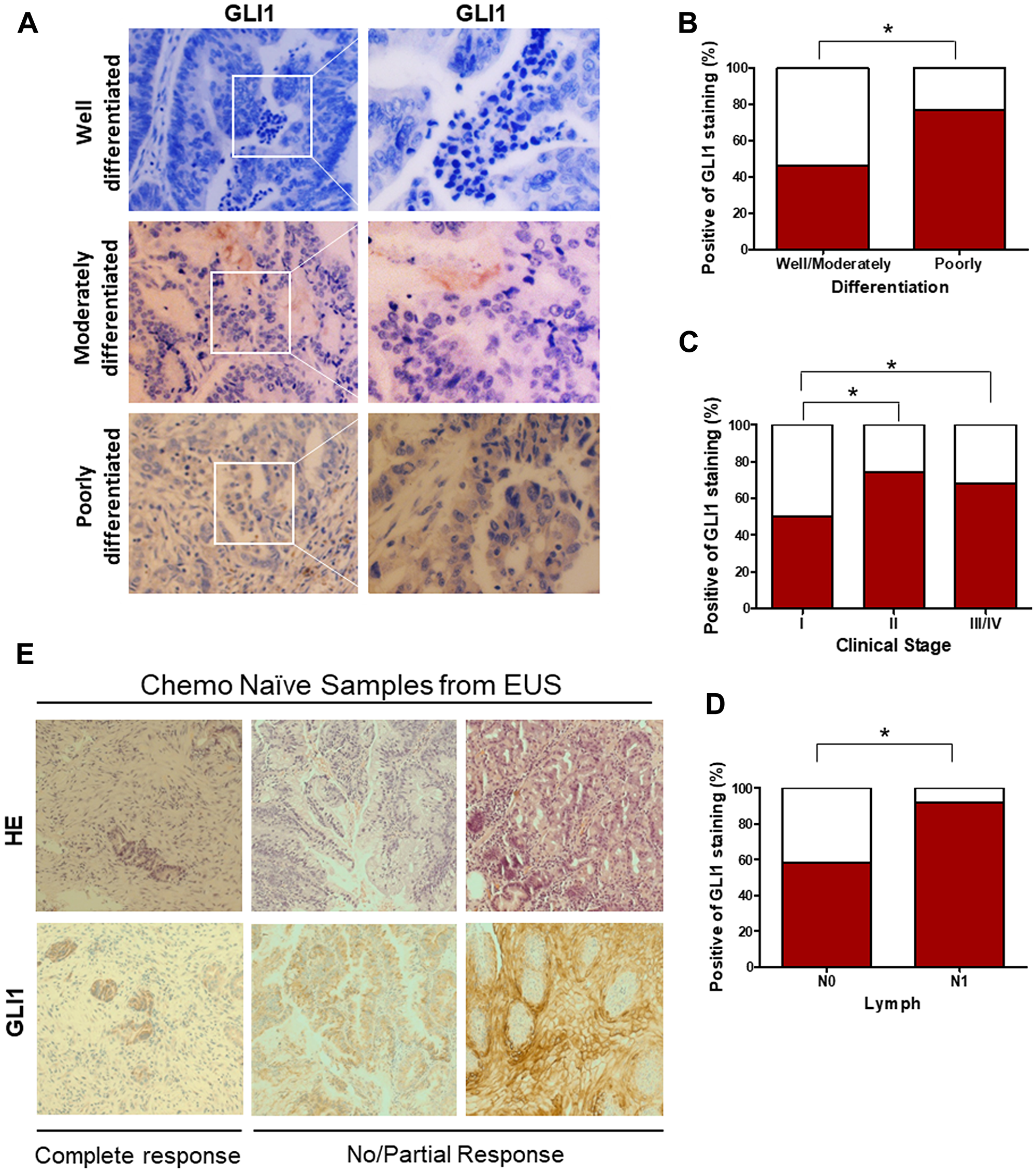 Elevated GLI1 activity is associated with the differentiation state and clinical stage of EAC, drives resistance to the chemotherapy.