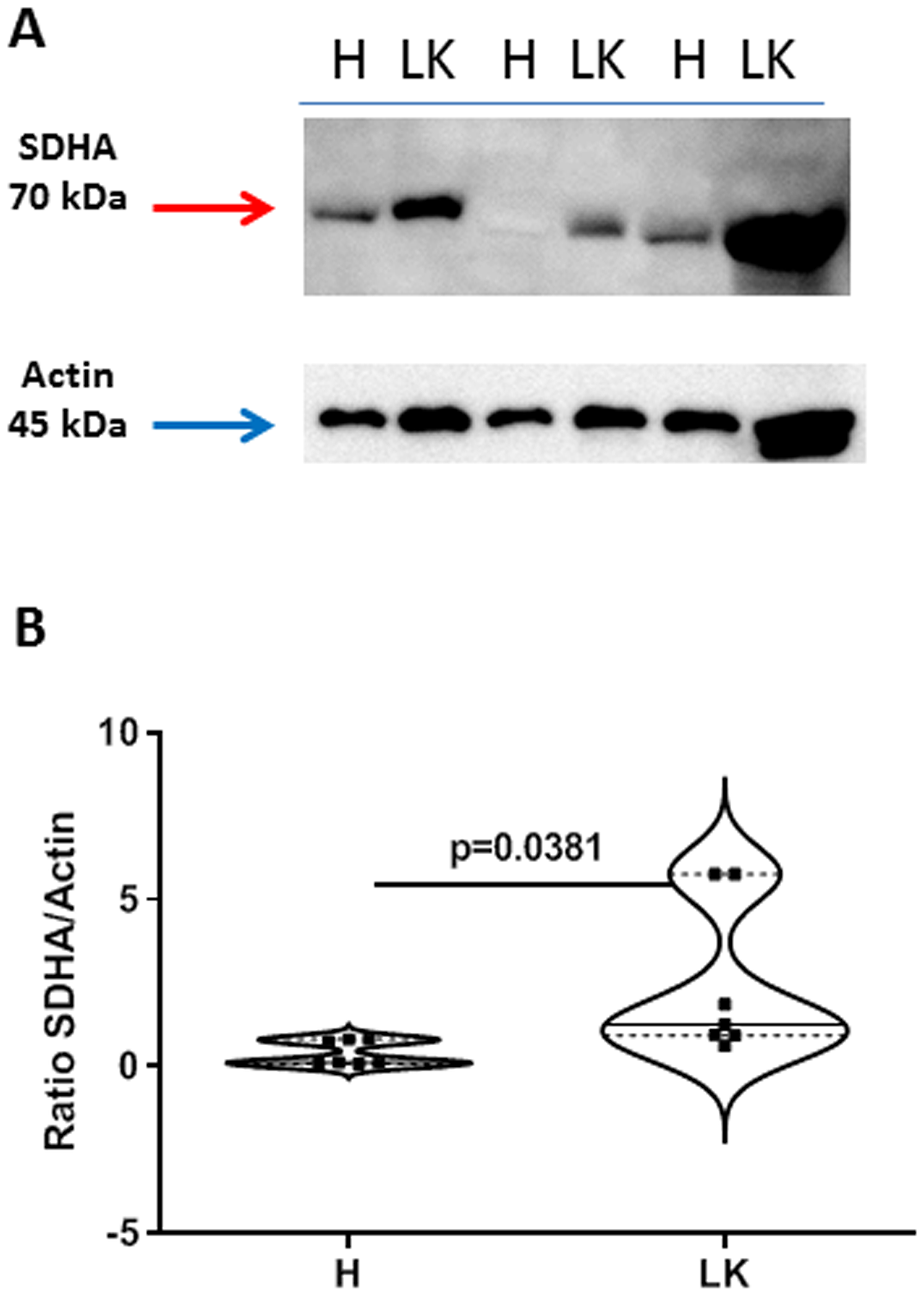 Expression of succinate dehydrogenase (SDHA) in non-cancerous (H) and cancerous (LK) collagenase-digested NSCLC tissues.