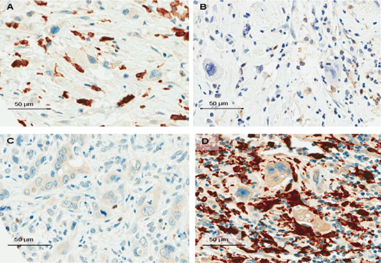 Snapshots of the tumor microenvironment of PDAC demonstrating tumor budding cells surrounded by numerous FOXP3+T-cells (A, x400, Bar:50&#x03BC;m); moderate counts of CD4+T-cells (B, x400, Bar:50&#x03BC;m); isolated iNOS-macrophages (C, x400, Bar:50&#x03BC;m) and dense infiltrates of CD163-macrophages (D, x400, Bar:50&#x03BC;m).