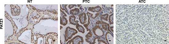 Representative images of PATZ1 staining in normal thyroid (NT), papillary thyroid carcinoma (PTC) and anaplastic thyroid carcinoma (ATC).