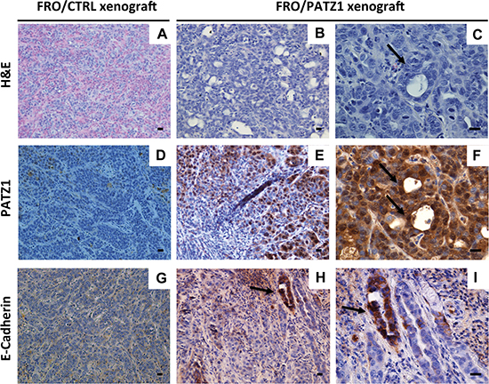 FRO/PATZ1 xenografts showed an epithelial-like phenotype.