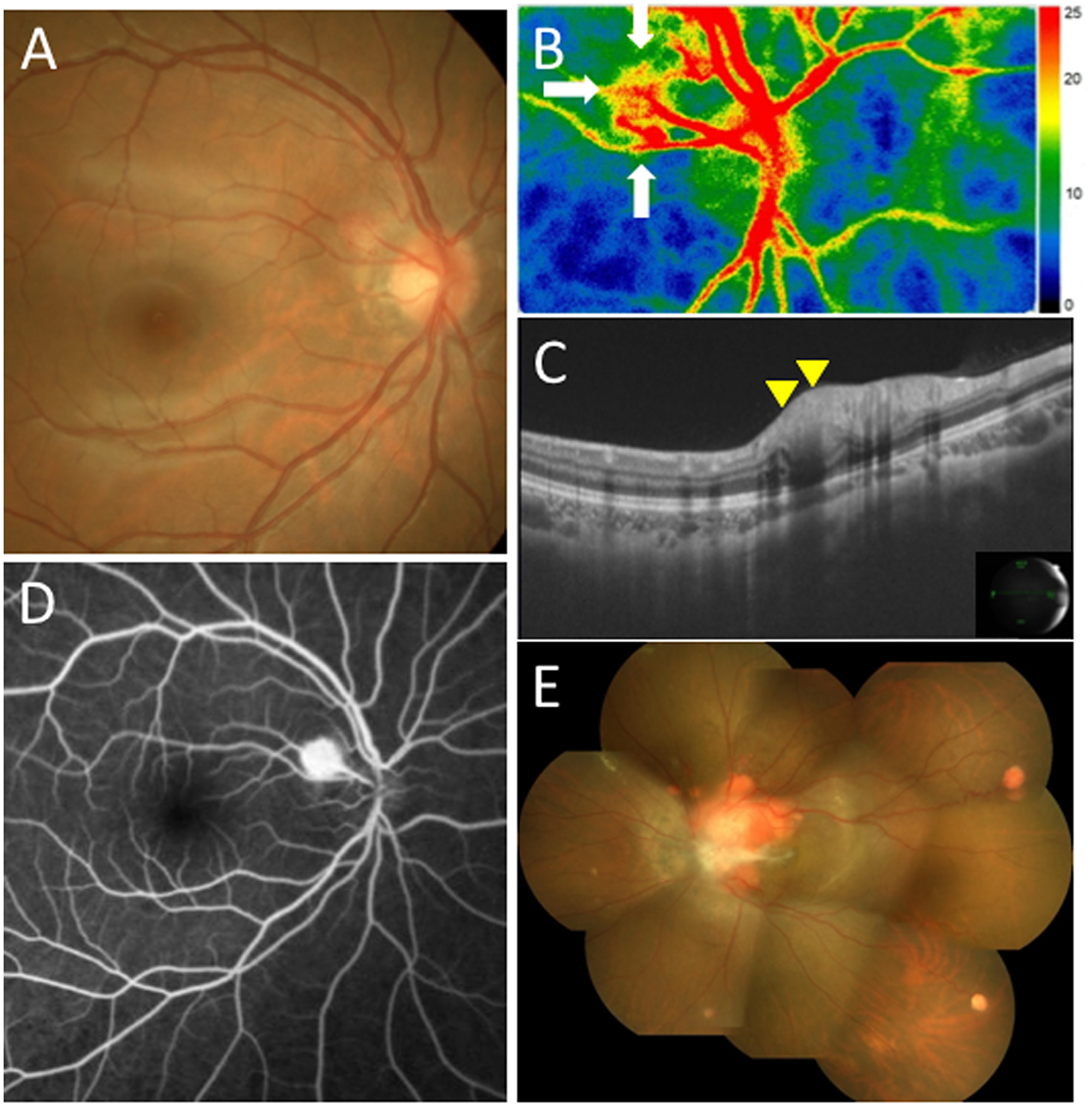 Initial findings on color fundus photography (CFP), swept-source optical coherence tomography (SS-OCT), laser speckle flowgraphy (LSFG), and fluorescein angiography (FA) in the present case with juxtapapillary retinal capillary hemangioblastoma (JRCH).