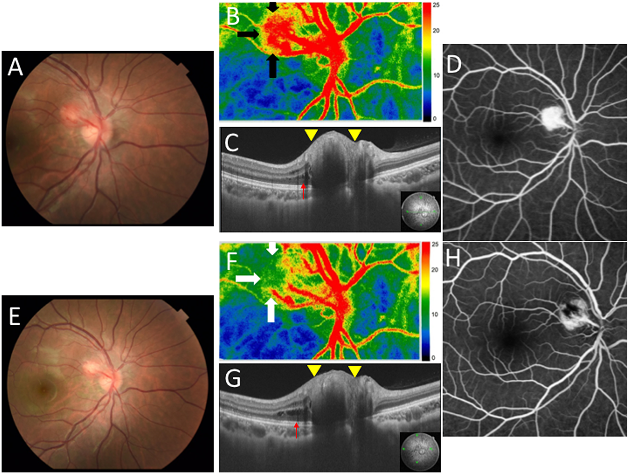 Ophthalmic findings before and after laser photocoagulation (LPC) in the present case with JRCH in the right eye.