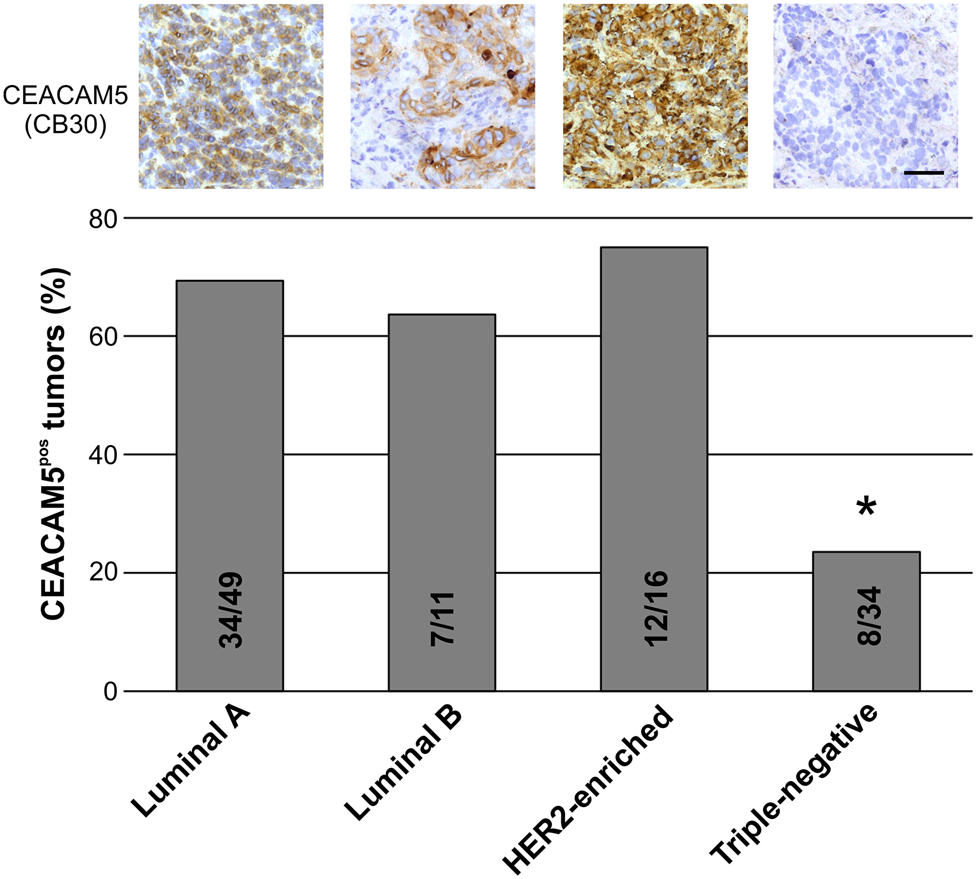 The proportion of CEACAM5-positive tumors are significantly higher in non-TN breast cancer subtypes.