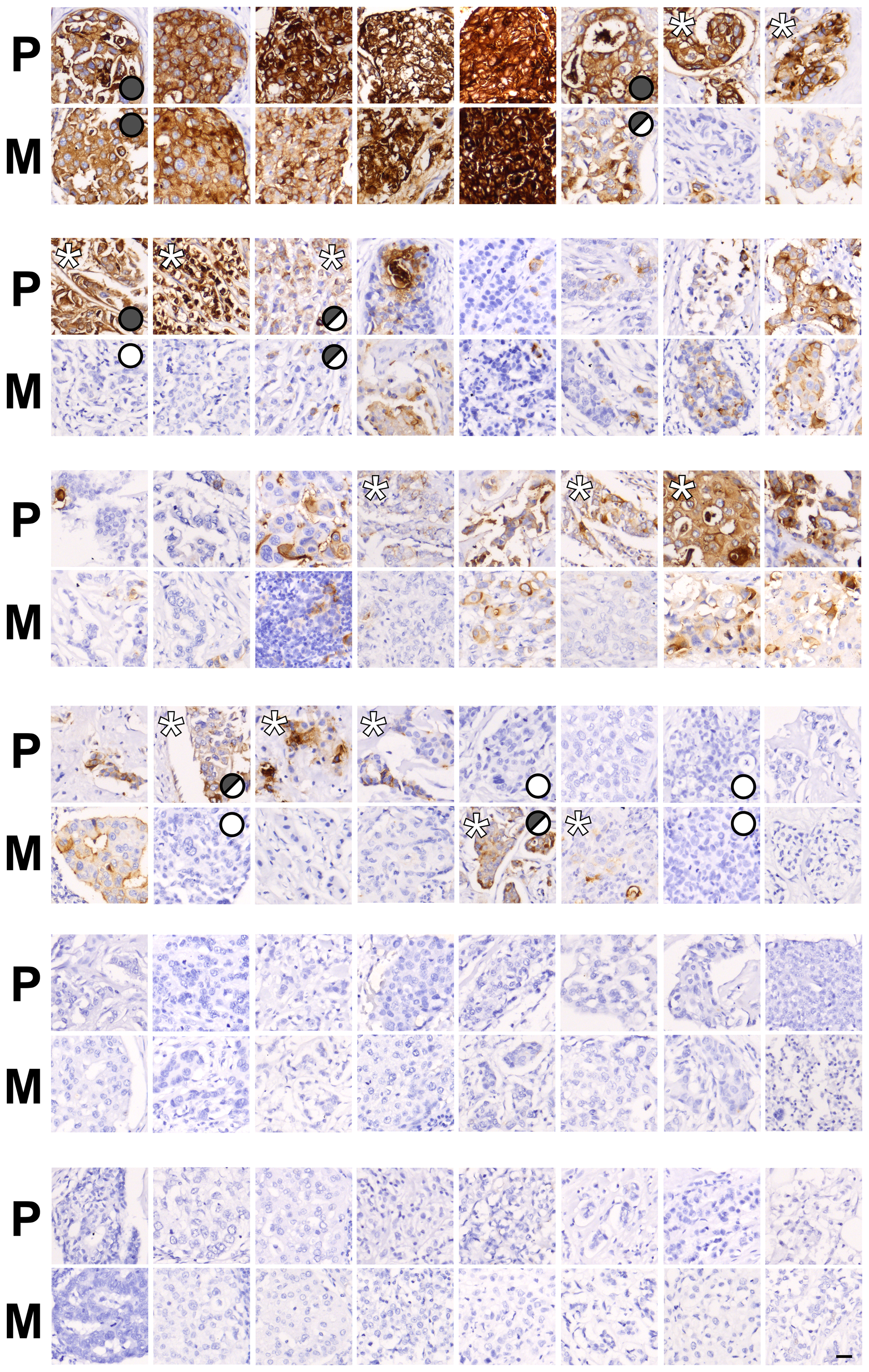 Pairs of primary breast cancer and lymph node metastases demonstrate different patterns of CEACAM5 expression.