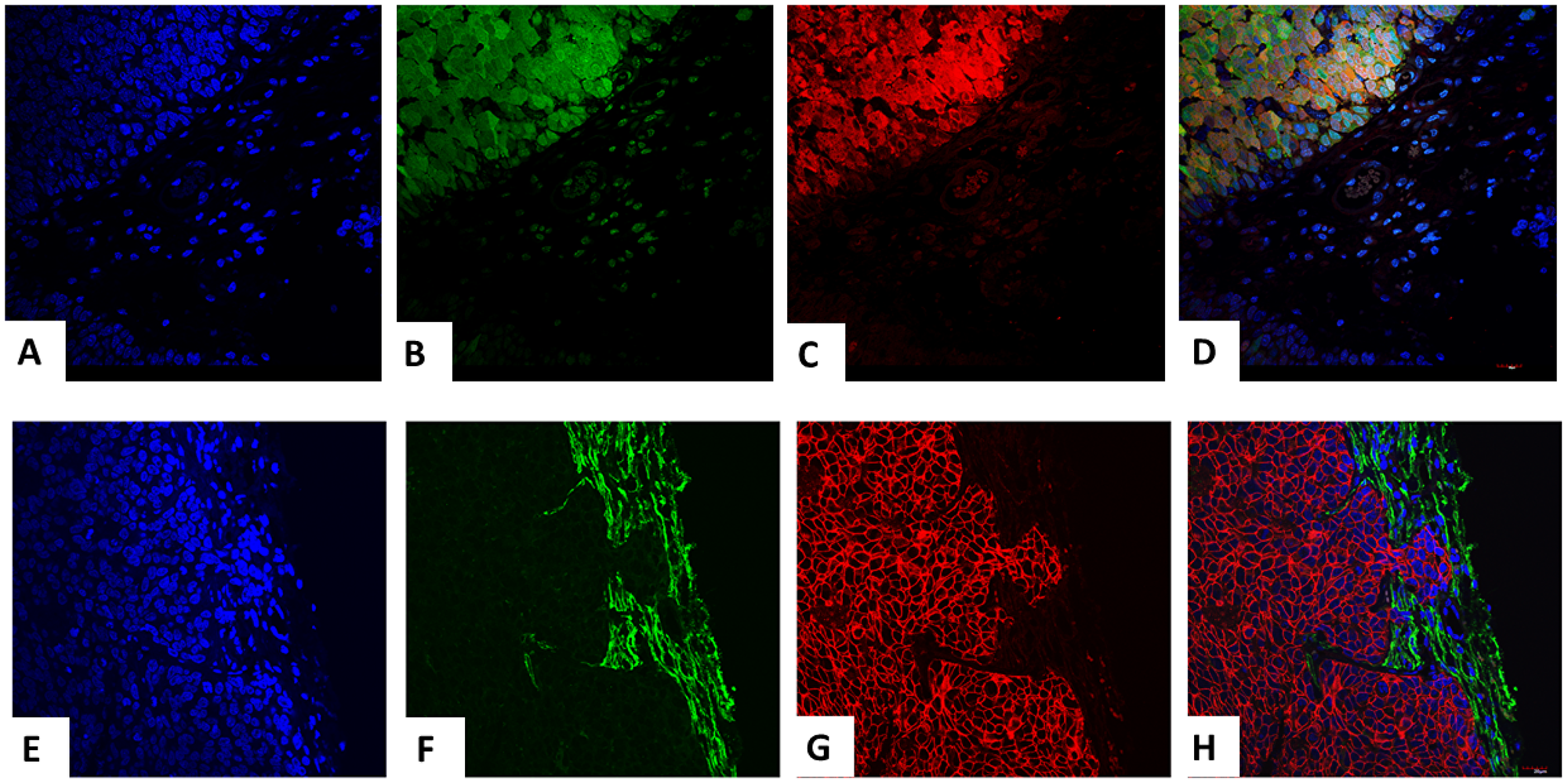 Trifluorescence studies of extirpated tumors in the transgenic-IPSC clones.