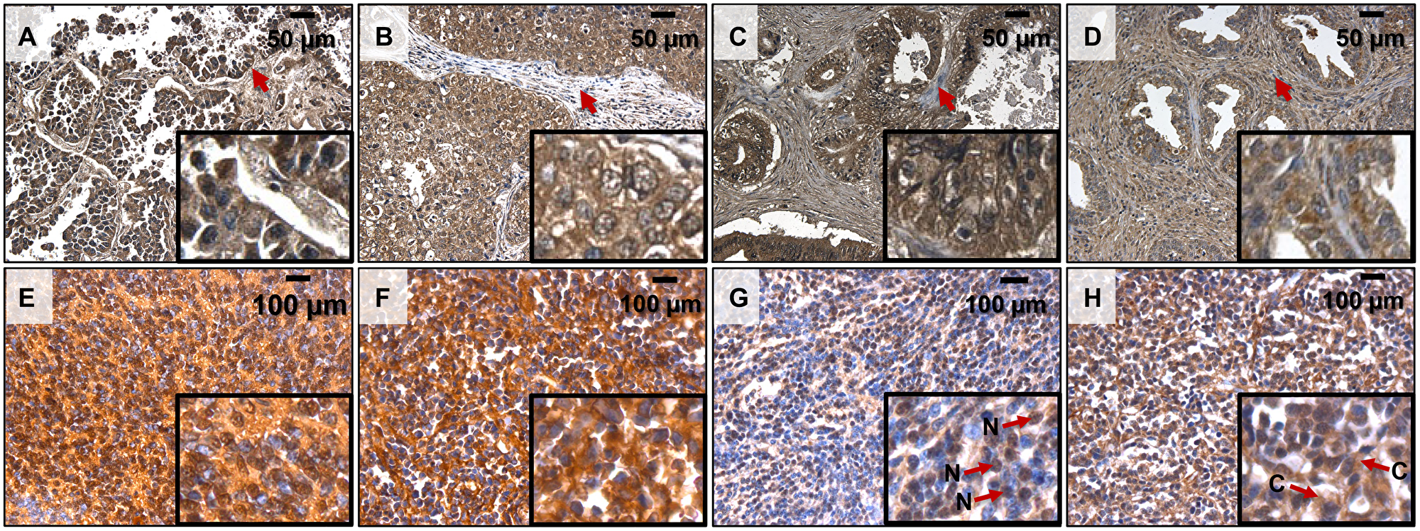 PolyP detection by immunohistochemistry in human cancer samples.