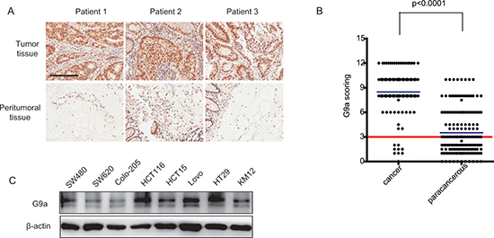 G9a is highly expressed in colorectal cancer.