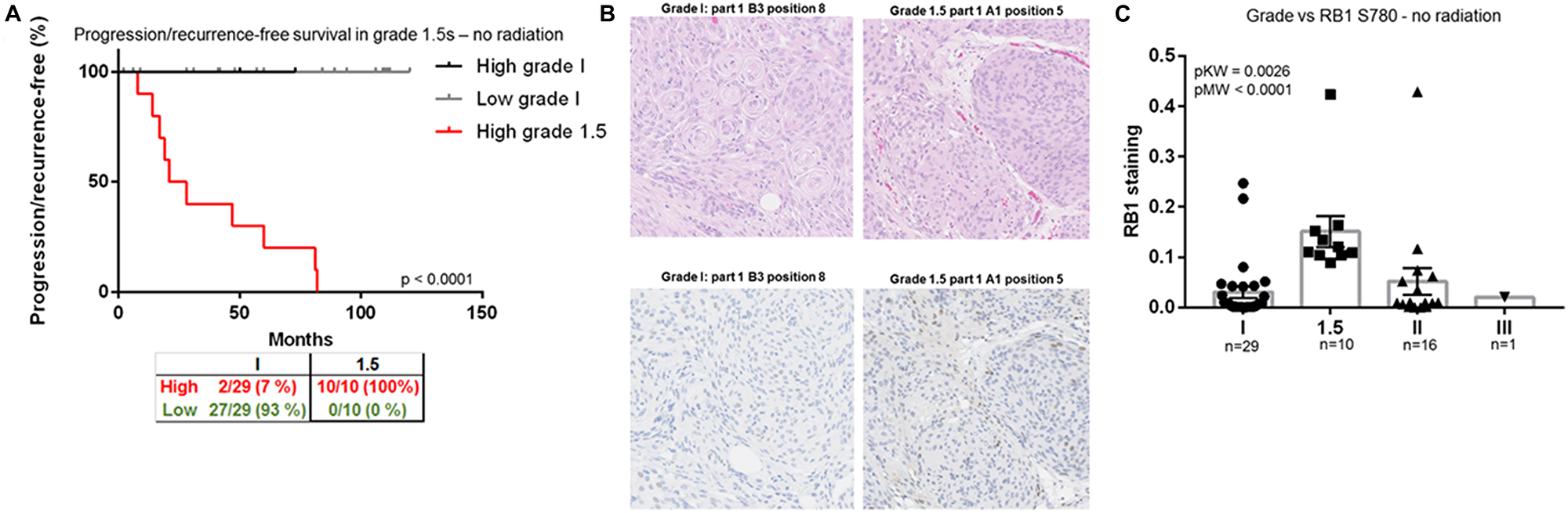 RB1, a biomarker for identification of grade 1.5 meningiomas.