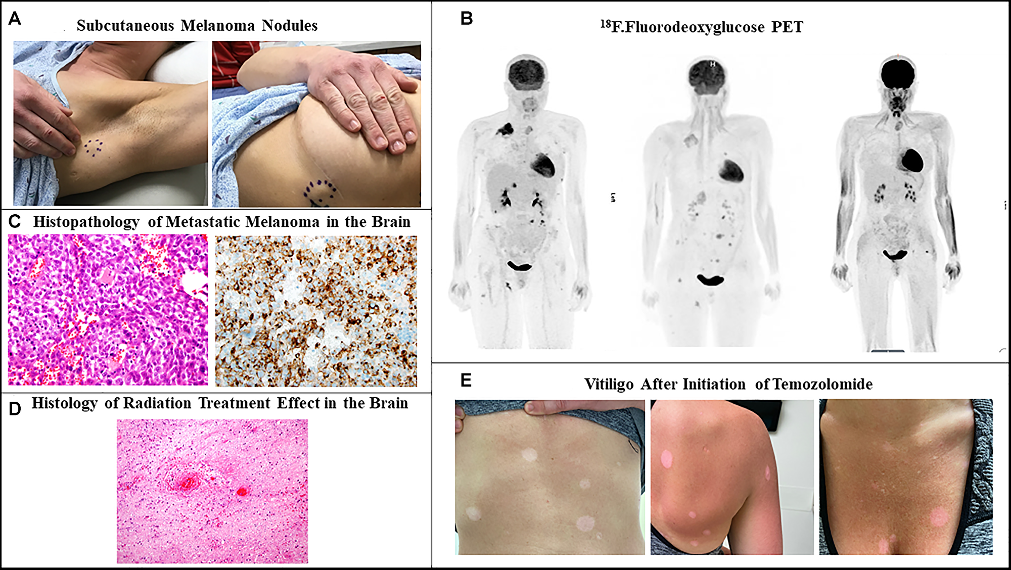 Recurrent metastatic melanoma.