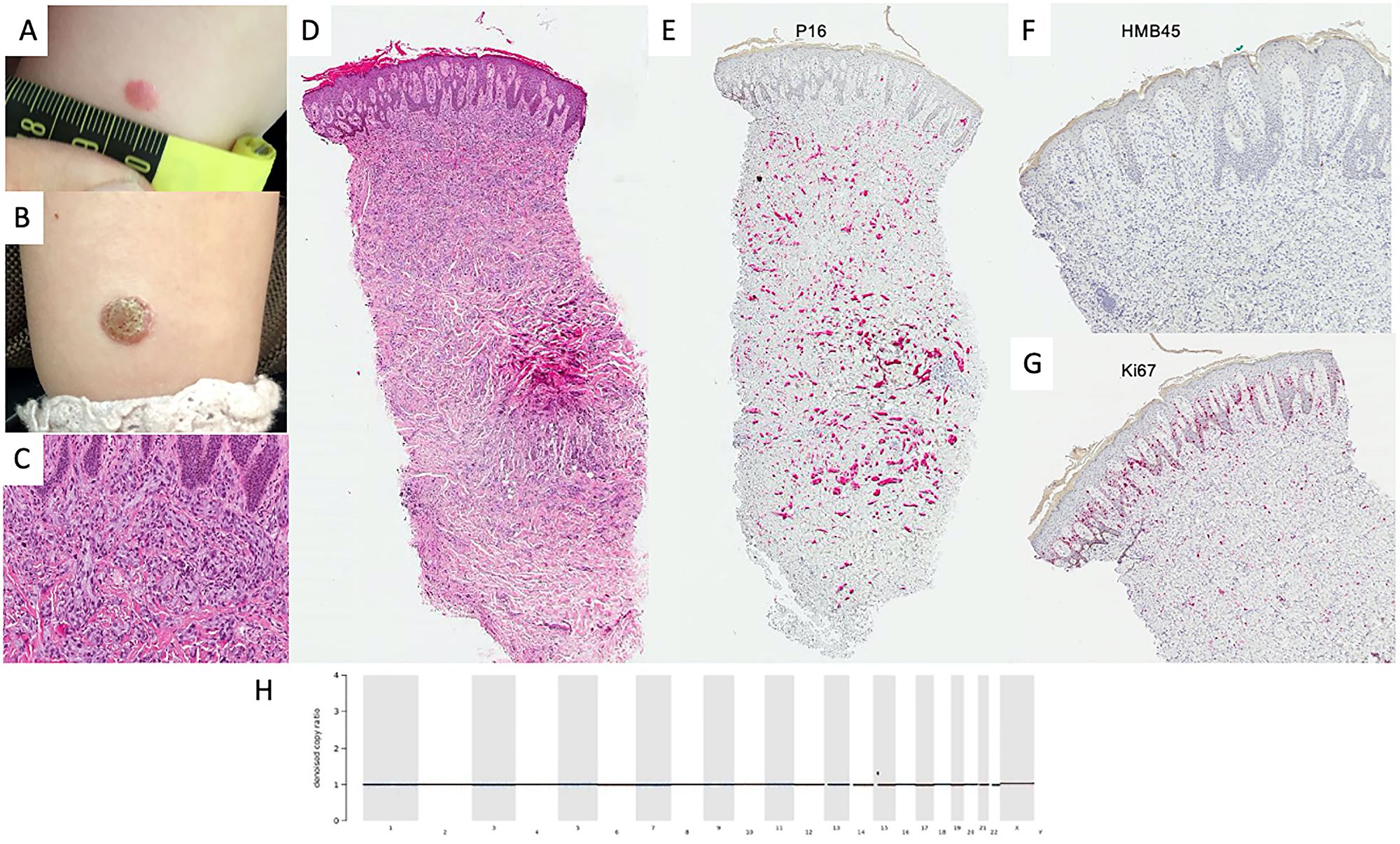 Diagnostics in benign spitzoid lesion.