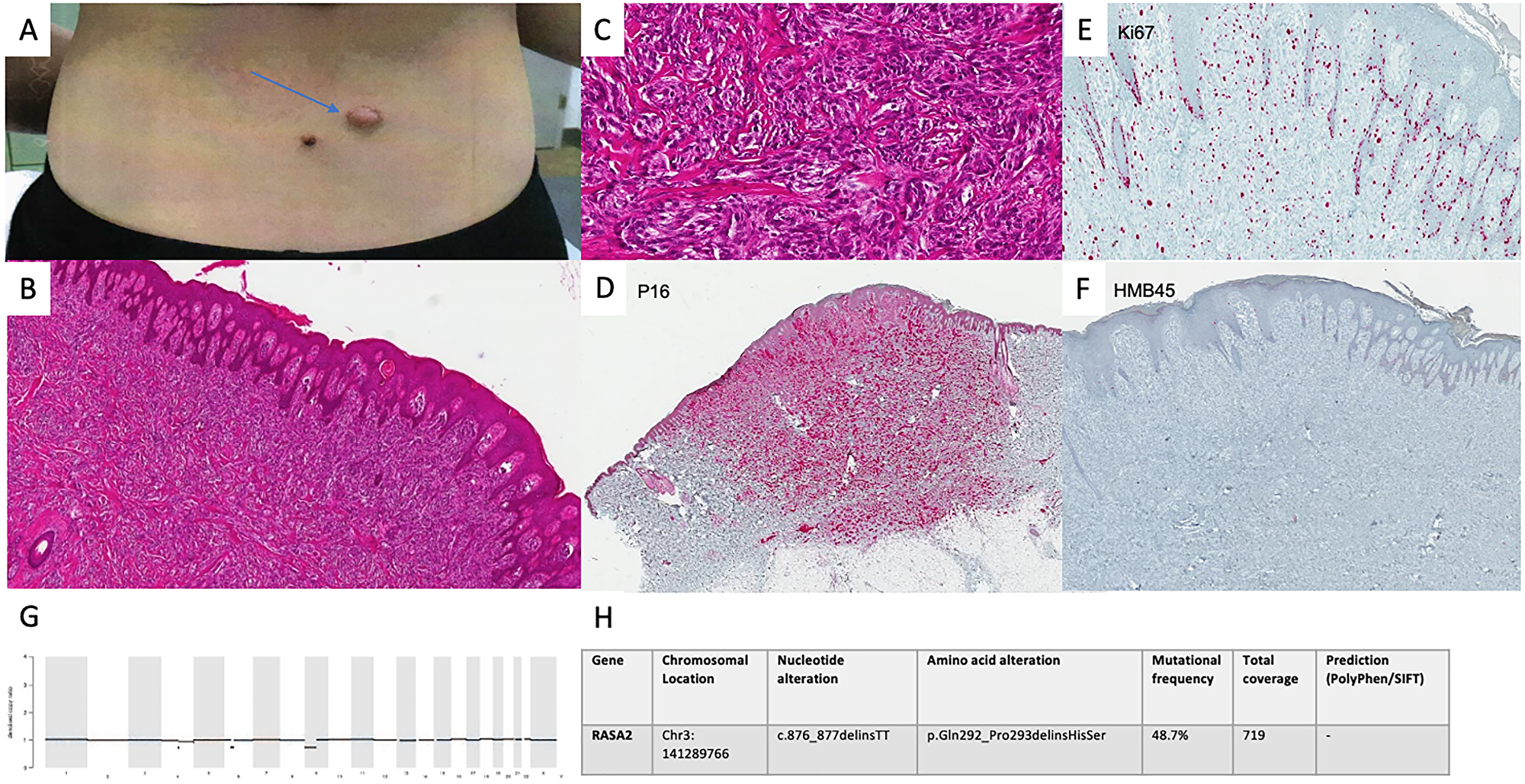 Diagnostics in intermediate spitzoid lesion.