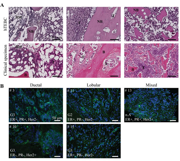 Tumor development in the hTEBC is representative of clinical bone metastases from breast carcinoma patients.