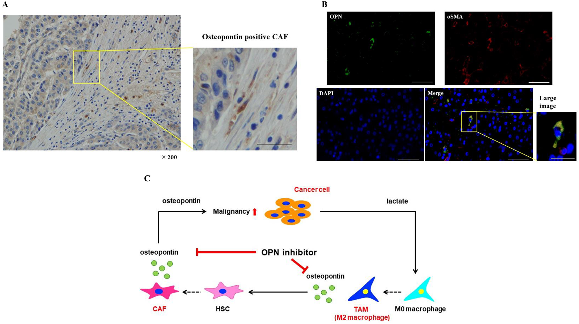 OPN positive CAFs were expressed in the tissues of HCC patients.